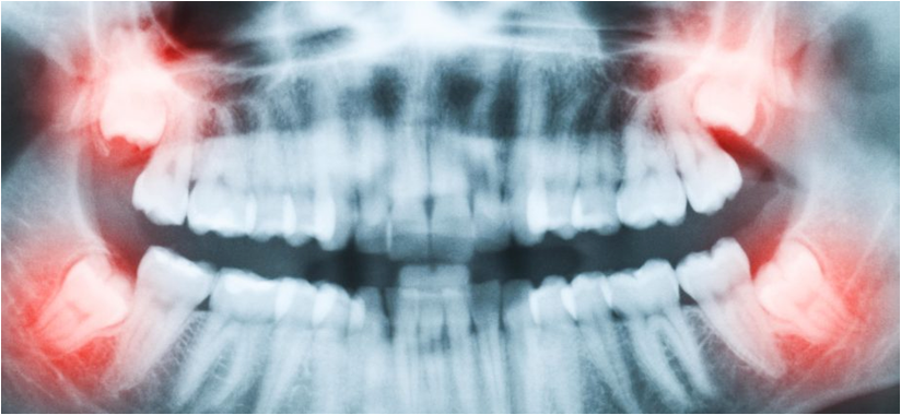 Painless Wisdom Tooth Removal